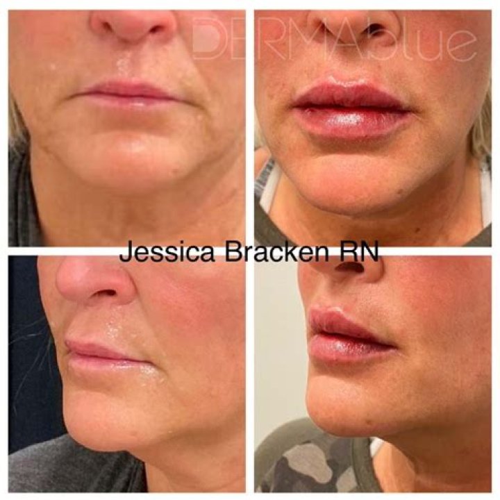 Jessica Alba's Lip Injections: A Closer Look
