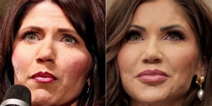 Kristi Noem: The Journey Of Transformation Through Plastic Surgery