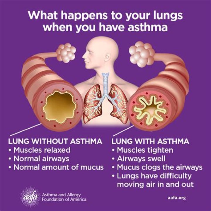 Understanding The Health Challenges Of Ambani's Son: The Asthma Journey