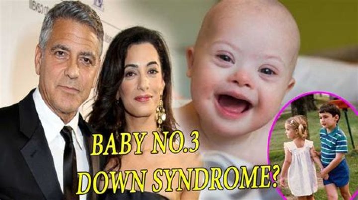 Unraveling The Truth: Does George Clooney’s Child Have Down Syndrome?