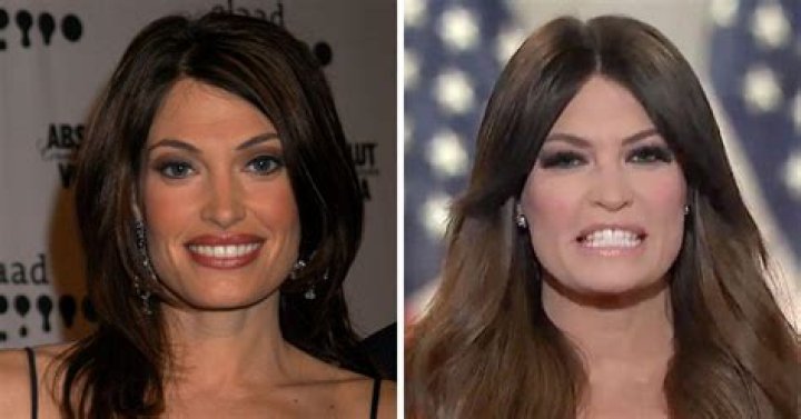 Unveiling The Truth Behind Kimberly Guilfoyle's Surgery
